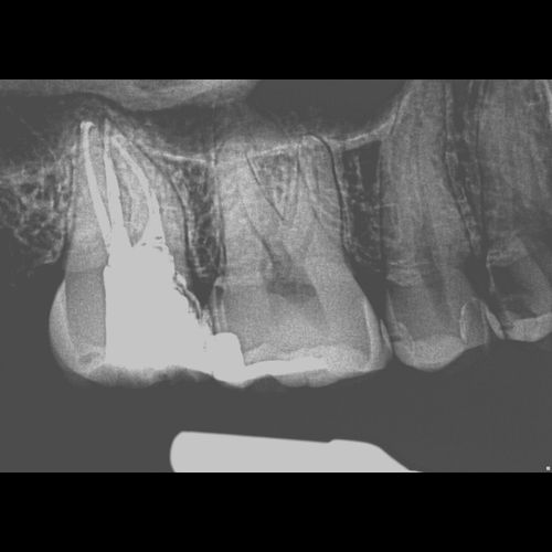 Second Molar Endodontics